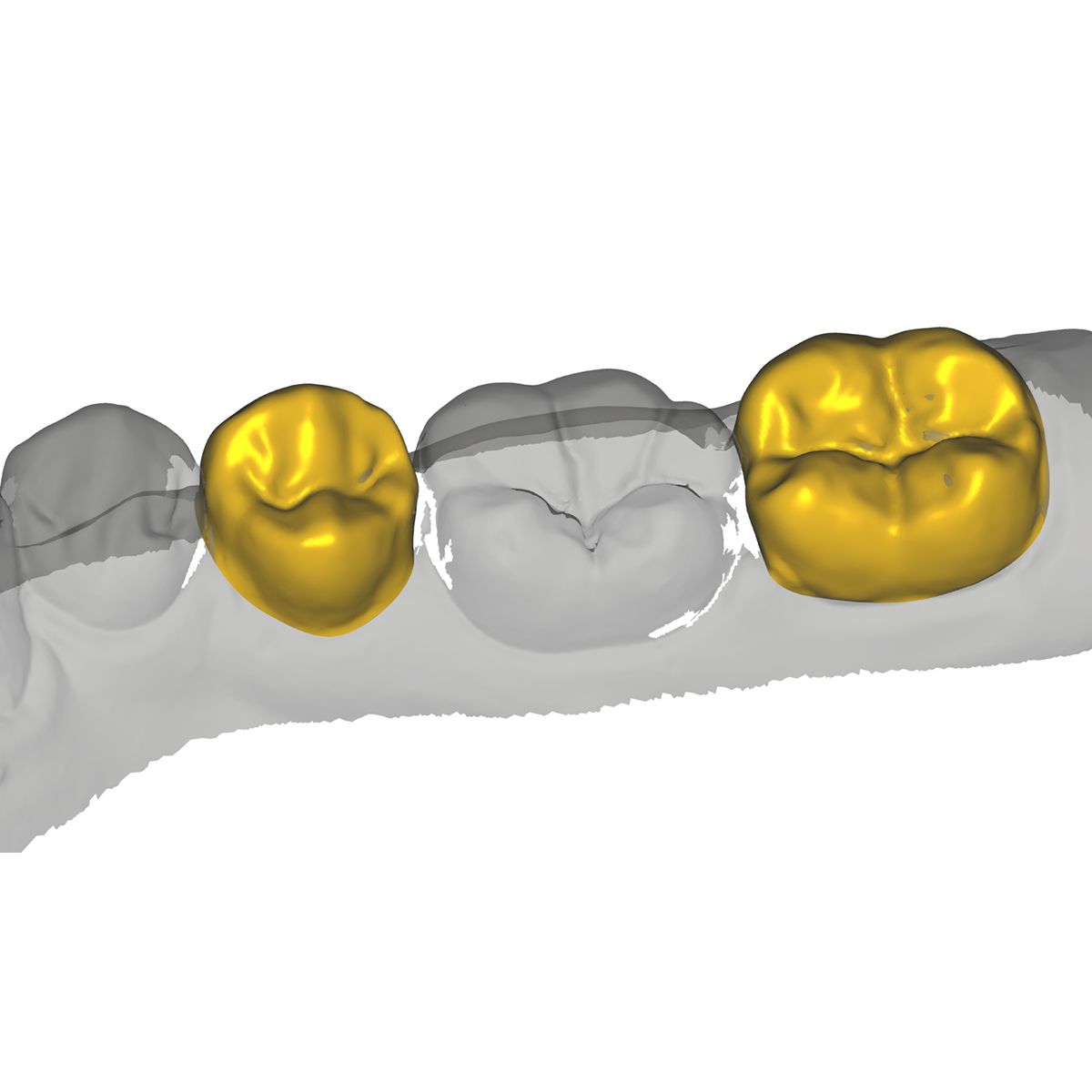 exocad provisional module - Bristol CadCam
